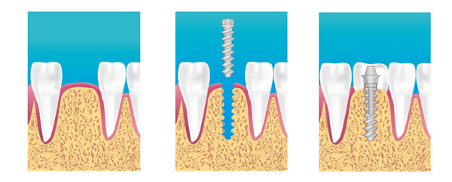 implant dentaire pre-saint-gervais